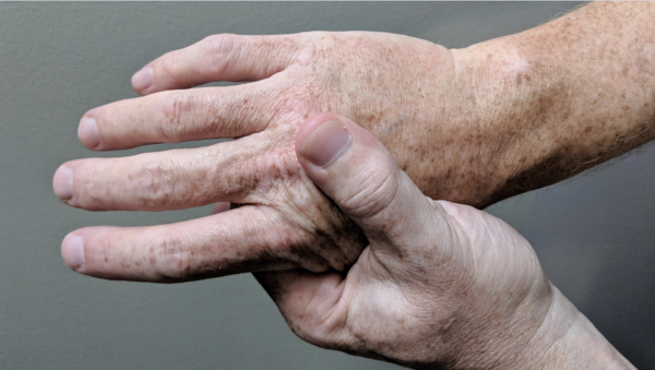 Arthritis in hands